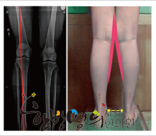 Knock-knees, Legs in the form of X, have a bean form of curvature. In other words, ... | 시선한의원