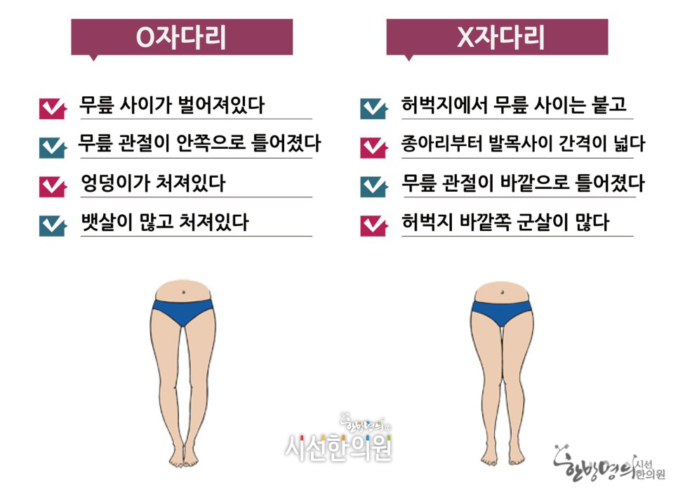 휜다리교정 | SEASUN Korean Medicine Clinic