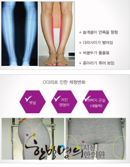 Bow legs, The curvature of the legs in the form of O refers to the state in ... | 시선한의원
