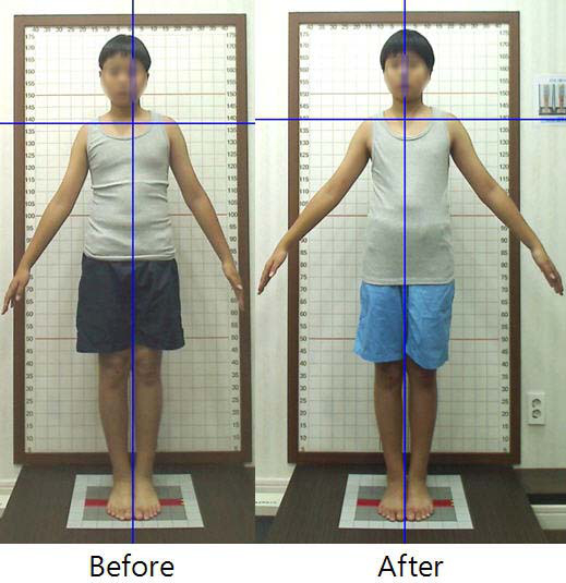 , Posture Analysis System | Клиника молодости СИСОН
